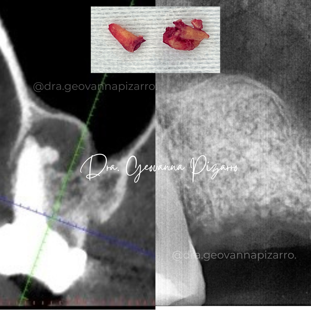 Proceso de regeneración ósea en implantes dentales